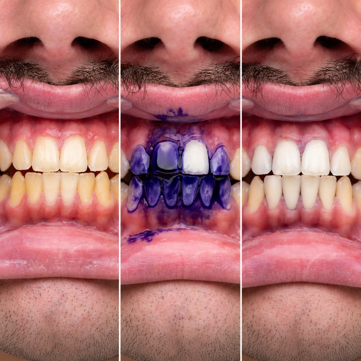 Smilevie – Soin Violet pour un Sourire Éclatant